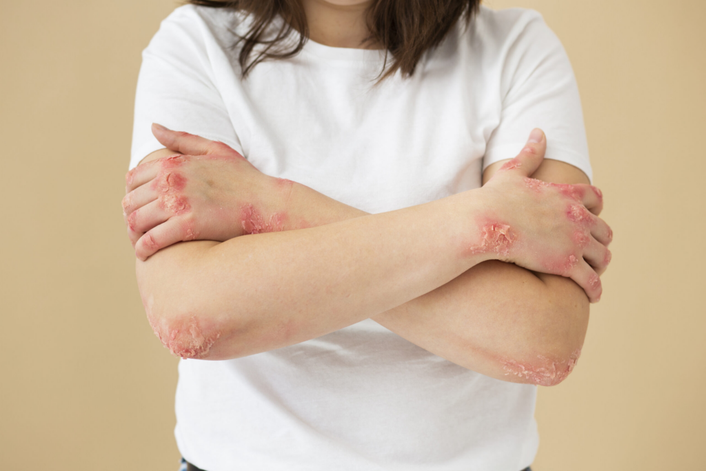 Dermatitis y psoriasis afectan cuerpo y mente
