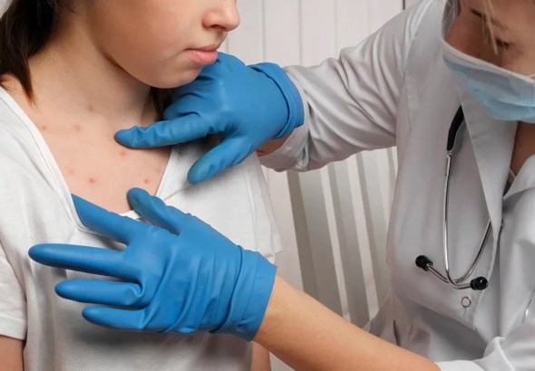 Emergencia sanitaria en Bangladesh por aumento de casos de sarampión